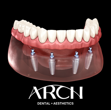 Snap-On Implant Dentures
